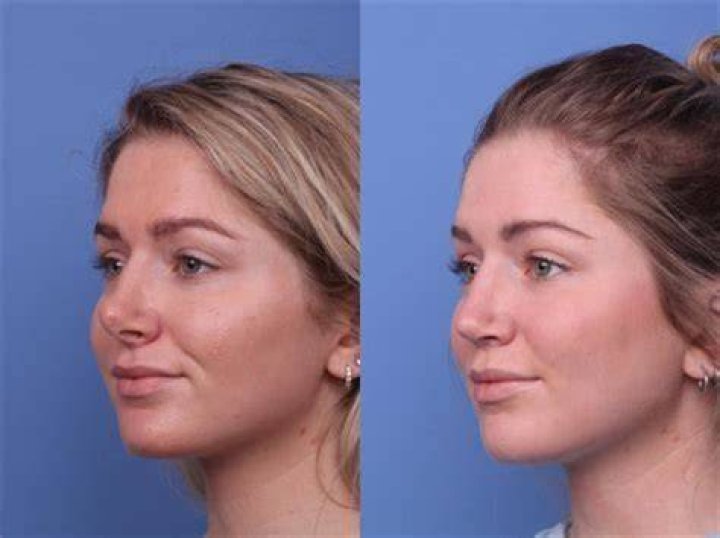 Holly Madison Nose Job Details – Before and After Photos and Plastic Surgery Explained